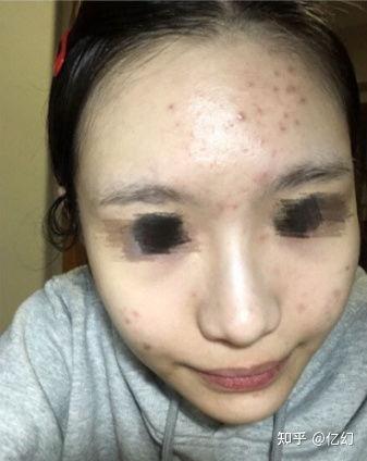 脸上长红痘表情包